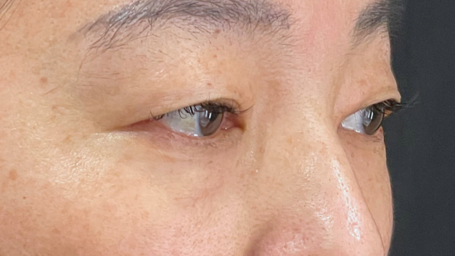 手术前的状态 其一