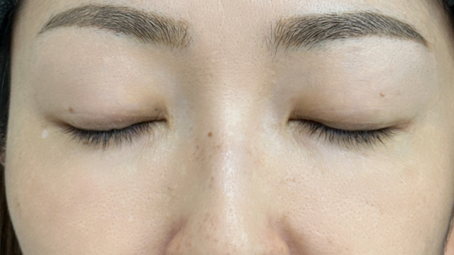 手术前的状态 其一