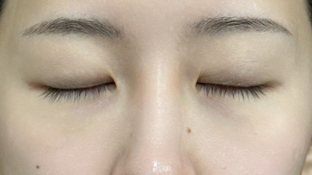 手术前的状态 其一