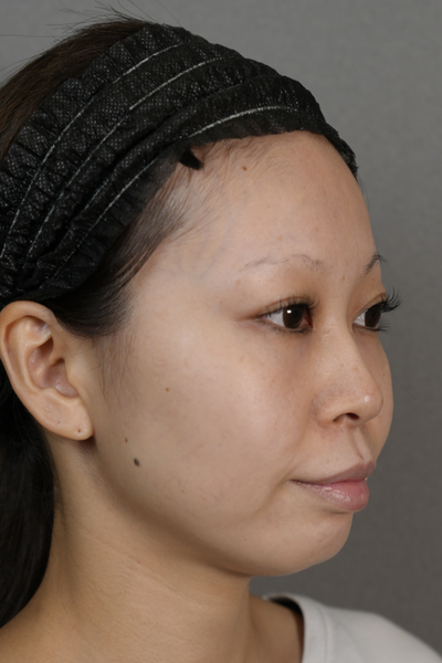 手术前的状态 其一