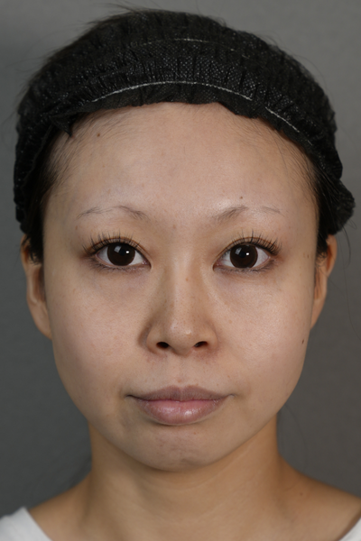 手术前的状态 其一