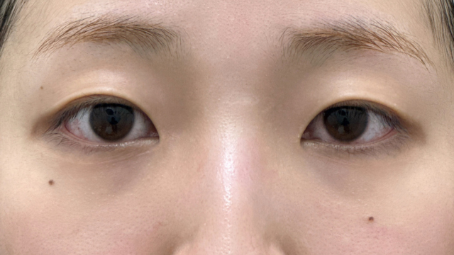 手术前的状态 其一