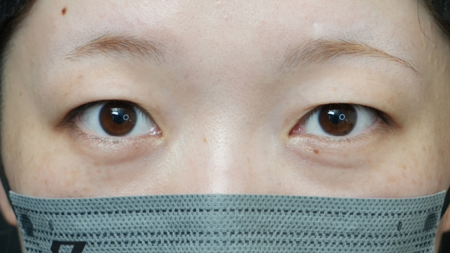 手术前的状态 其一