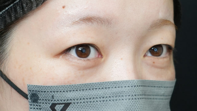 手术前的状态 其一