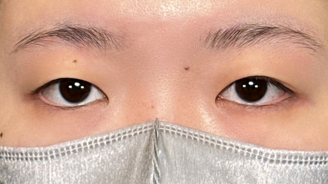 手术前的状态 其一