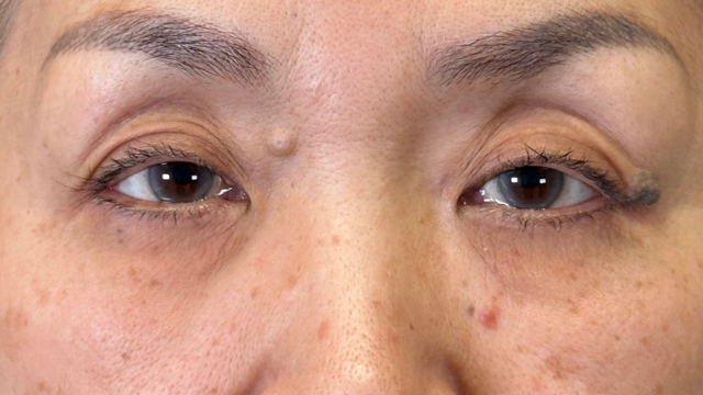 Preoperative Condition Part 1