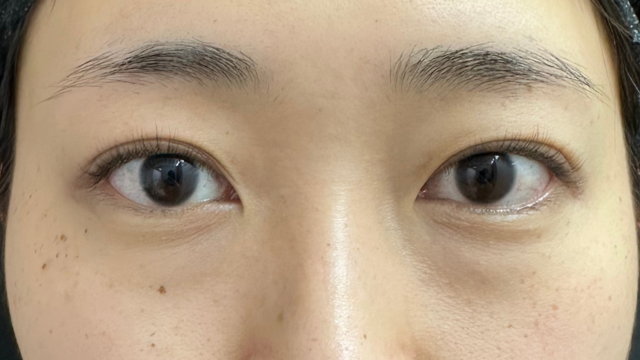 手术前的状态 其一