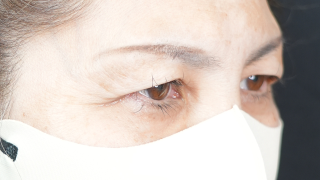 手术前的状态 其一