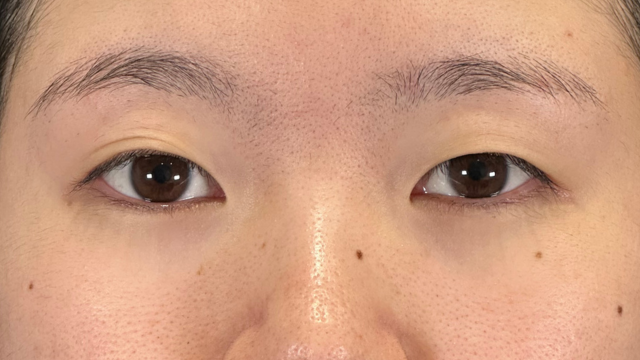 手术前的状态 其一