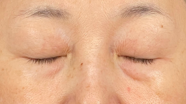 手术前的状态 其一