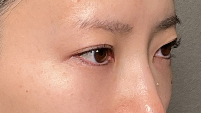 手术前的状态 其一