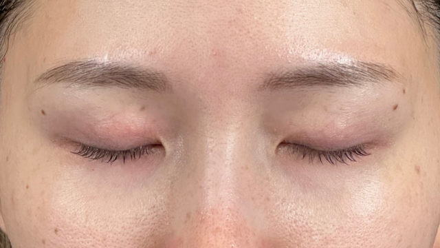 Preoperative Condition Part 1