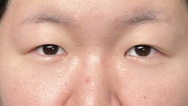 手术前的状态 其一