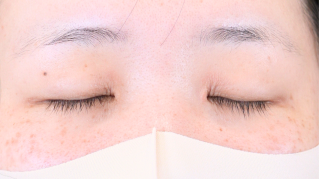 Preoperative Condition Part 1