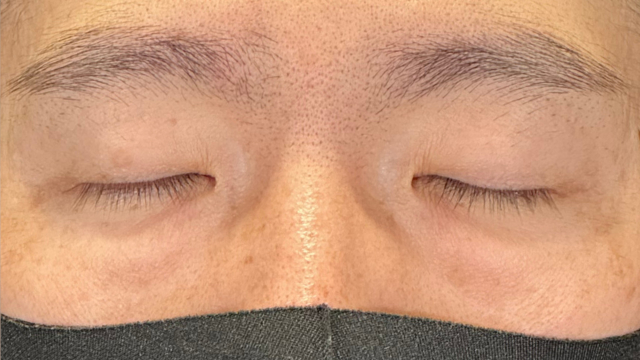 手术前的状态 其一