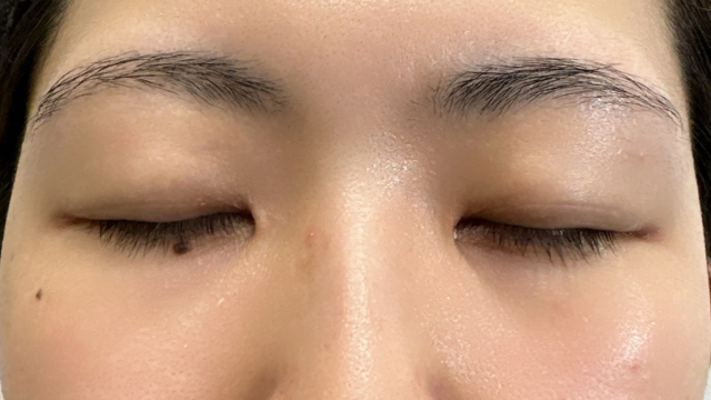 手术前的状态 其一