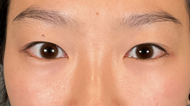 手术前的状态 其一