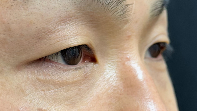 手术前的状态 其一