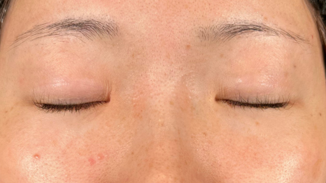 手术前的状态 其一