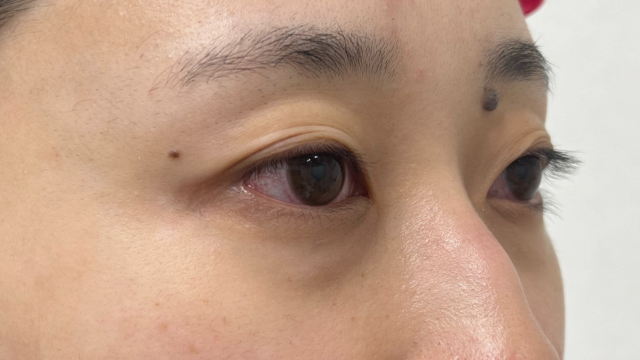 手术前的状态 其一