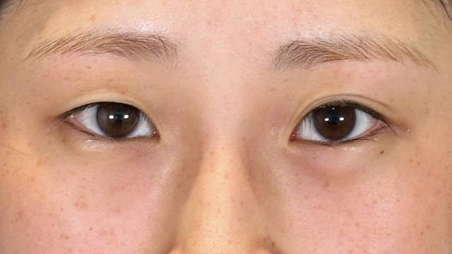 手术前的状态 其一