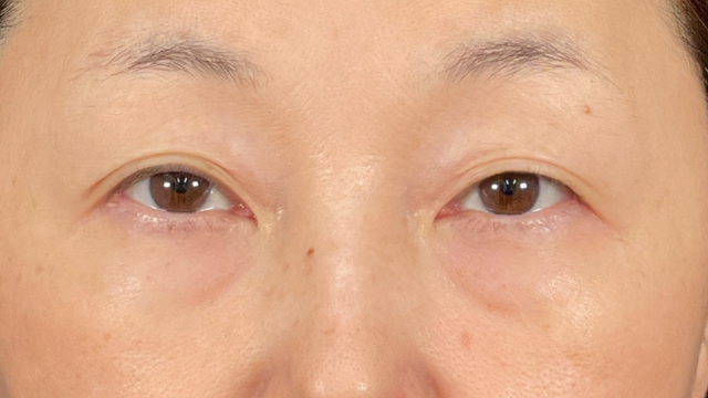 手术前的状态 其一