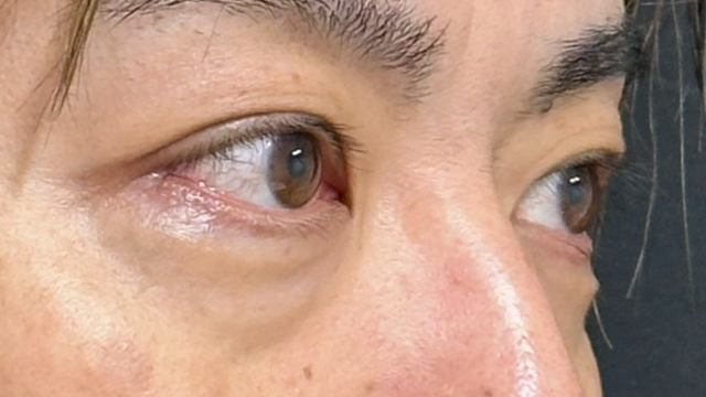 手术前的状态 其一