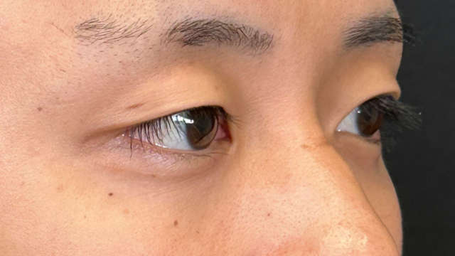 手术前的状态 其一