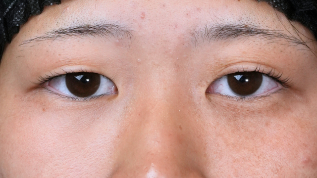 手术前的状态 其一