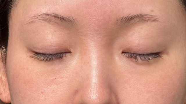 手术前的状态 其一