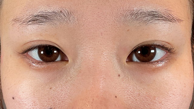 手术前的状态 其一