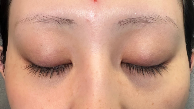 手术前的状态 其一