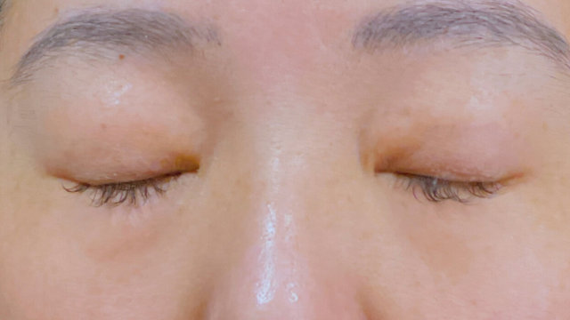 手术前的状态 其一