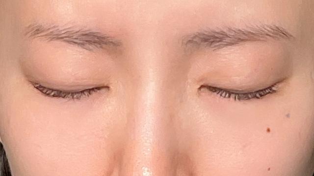 手术前的状态 其一