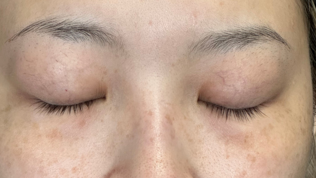 手术前的状态 其一