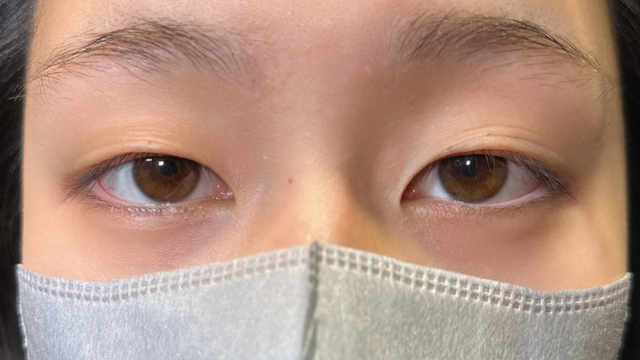 手术前的状态 其一