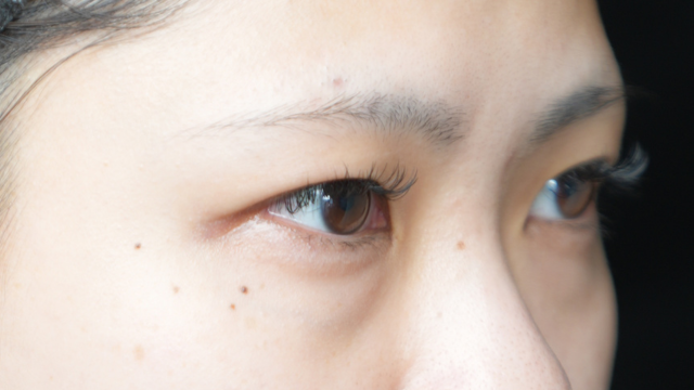 手術前の状態 その1