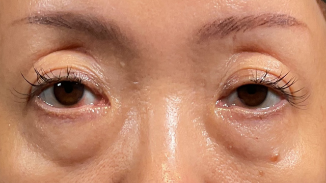 手術前の状態 その1