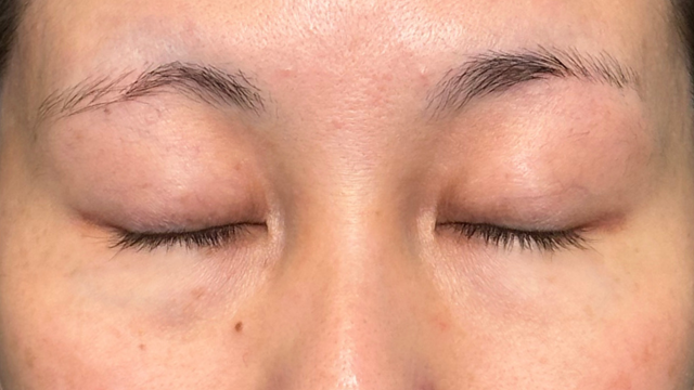 手術前の状態 その1