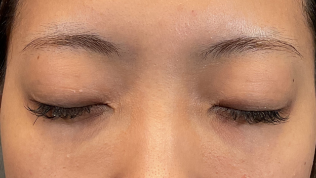 手術前の状態 その1