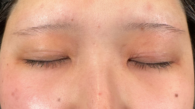 手術前の状態 その1