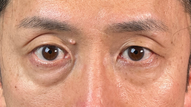 手術前の状態 その1