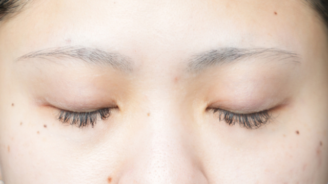 手術前の状態 その1