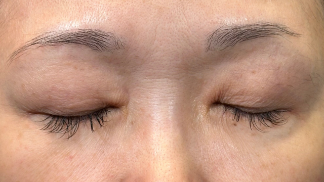 手術前の状態 その1