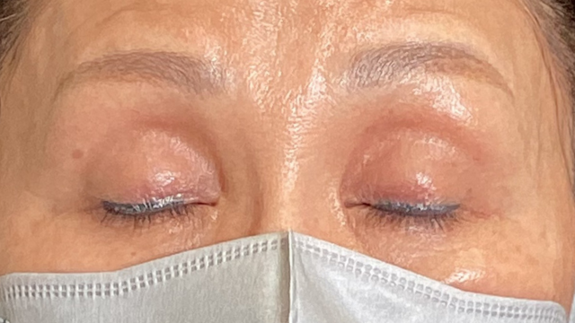 手術前の状態 その1