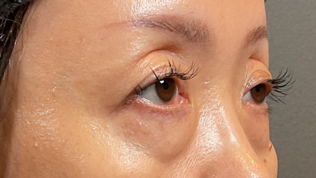 手術前の状態 その1