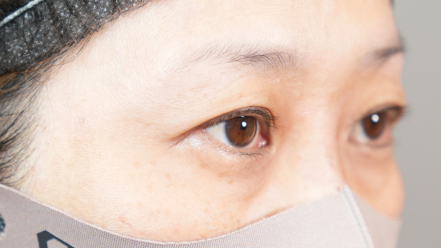 手術前の状態 その1