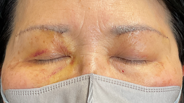 手術前の状態 その1