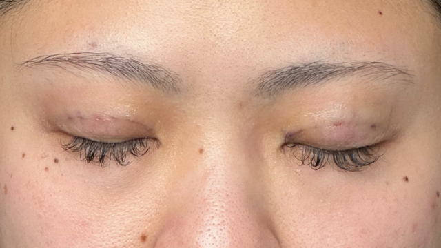 手術前の状態 その1