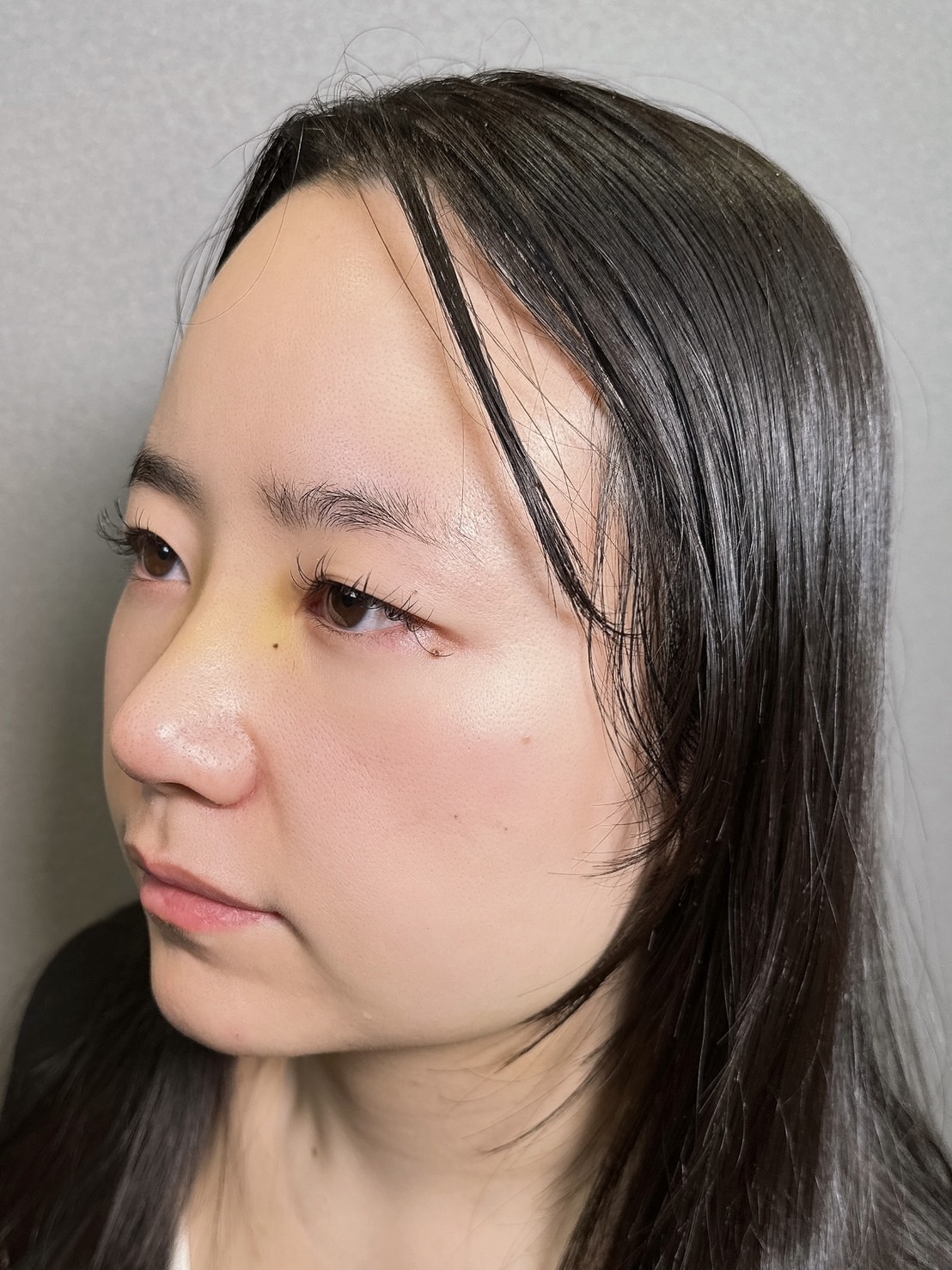 手術前の状態 その1